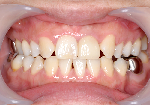 ひかりのテラス歯科クリニックのセラミック症例
