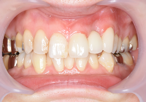 ひかりのテラス歯科クリニックのセラミック症例