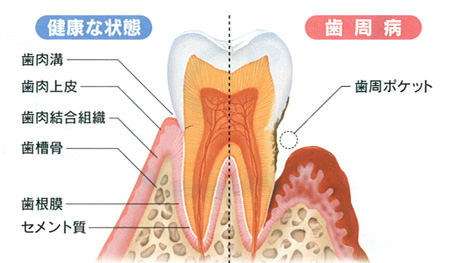 歯周病 いわき市の歯医者 歯科 ひかりのテラス歯科クリニック