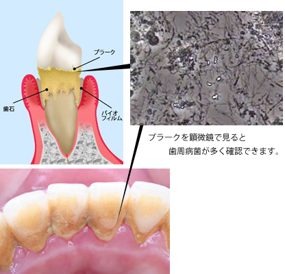 歯周病 いわき市の歯医者 歯科 ひかりのテラス歯科クリニック