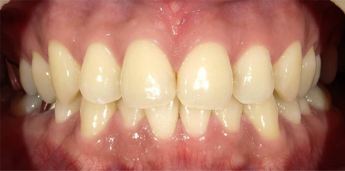 ひかりのテラス歯科クリニックのホワイトニング症例