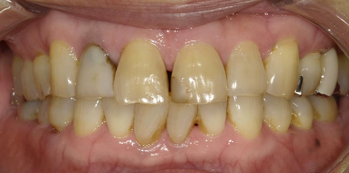 ひかりのテラス歯科クリニックのホワイトニング症例